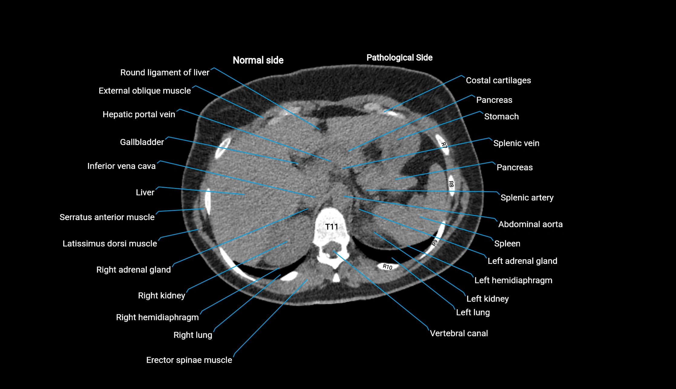CT KUB axial cross sectional anatomy  radiology image -img-00201-00017.webp